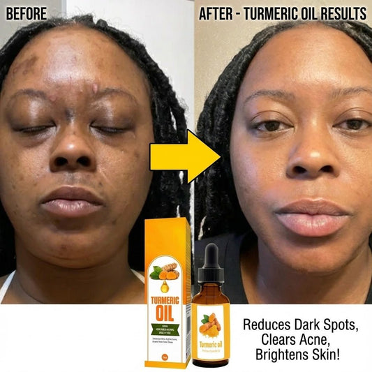 Lwil Timerik 30ml - Pou Vizaj la, Serom Timerik pou Tach Nwa, Serom Korektè Pou Vizaj ak Kò, Serom Vizaj Anti - Vyeyisman Pou Fanm ak Gason, Diminye Ipèpigmantasyon - LakayFinds.com